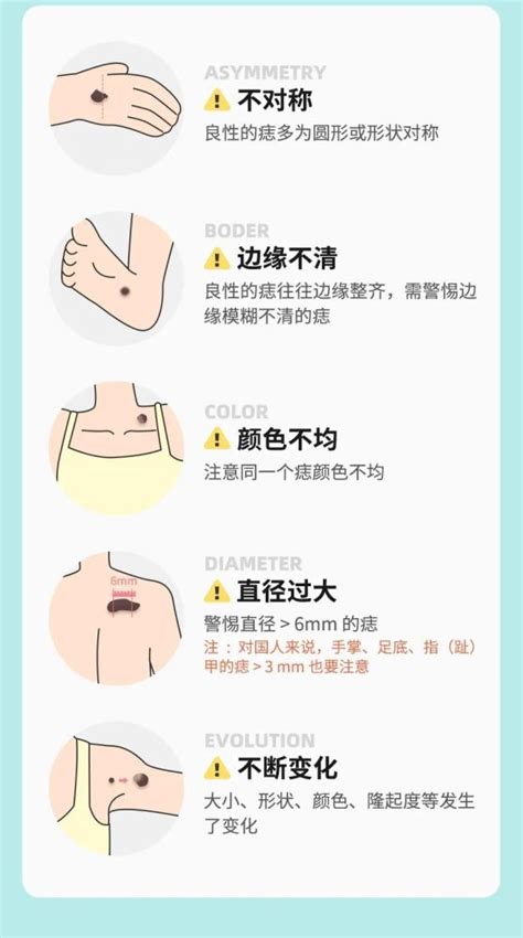 腋下痣|痣也可能会癌变！长在 3 个地方要注意